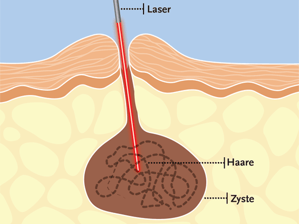 Fistula laser technology